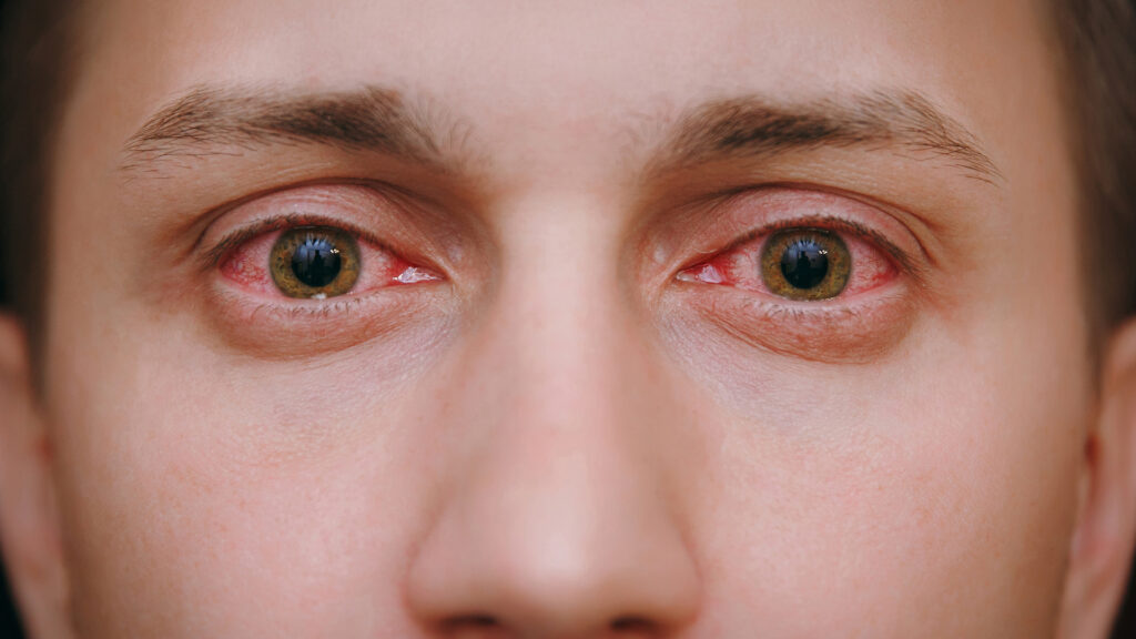 Clearing the View A Comprehensive Guide to How CBD Can Treat Conjunctivitis