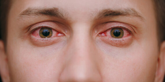 Clearing the View A Comprehensive Guide to How CBD Can Treat Conjunctivitis